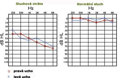 Ukázka audiogramu ztráty sluchu