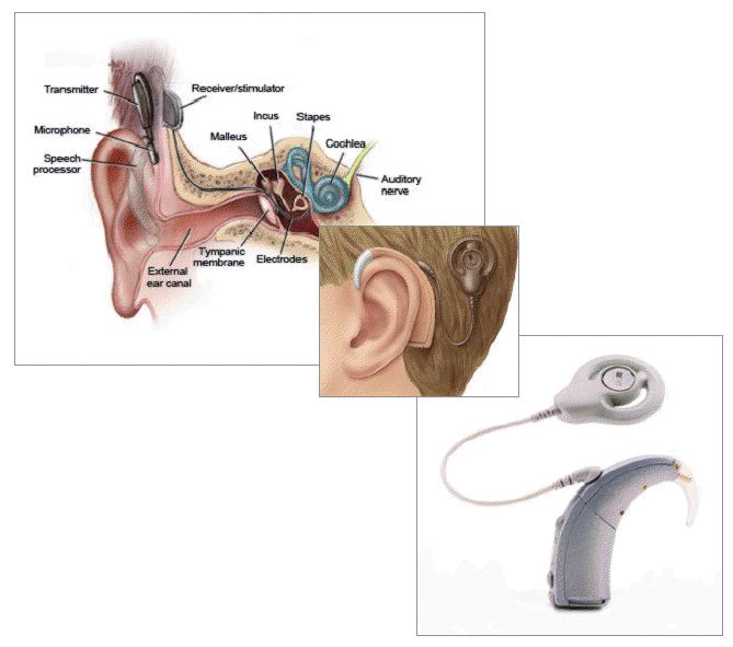 Kochleární implantát